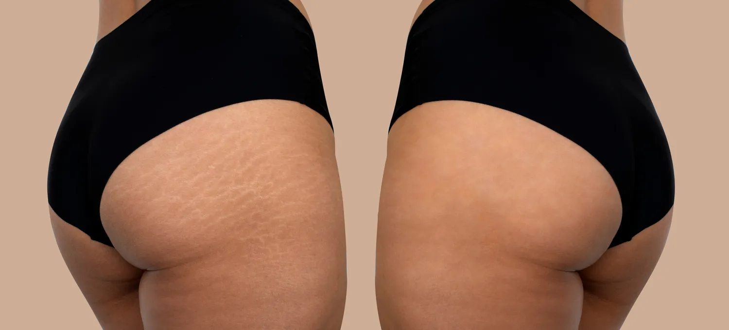 Stretch Mark Camouflage Chicago | OMSPA